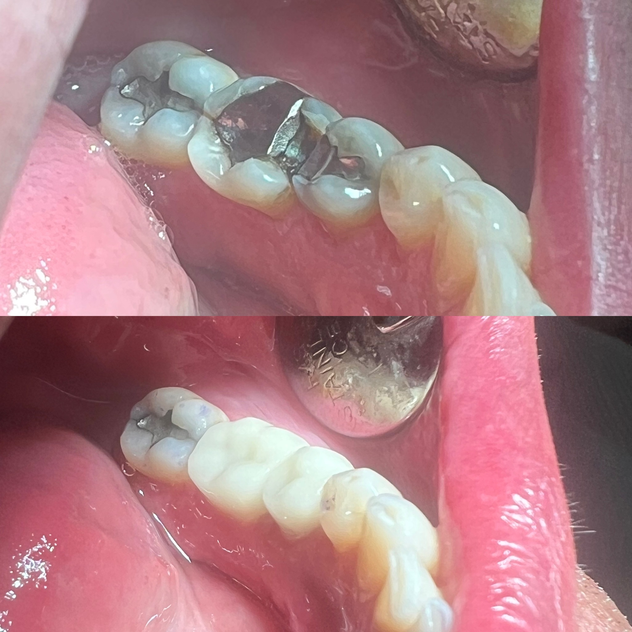 Two Fractured Teeth Same Day Crown Restorations